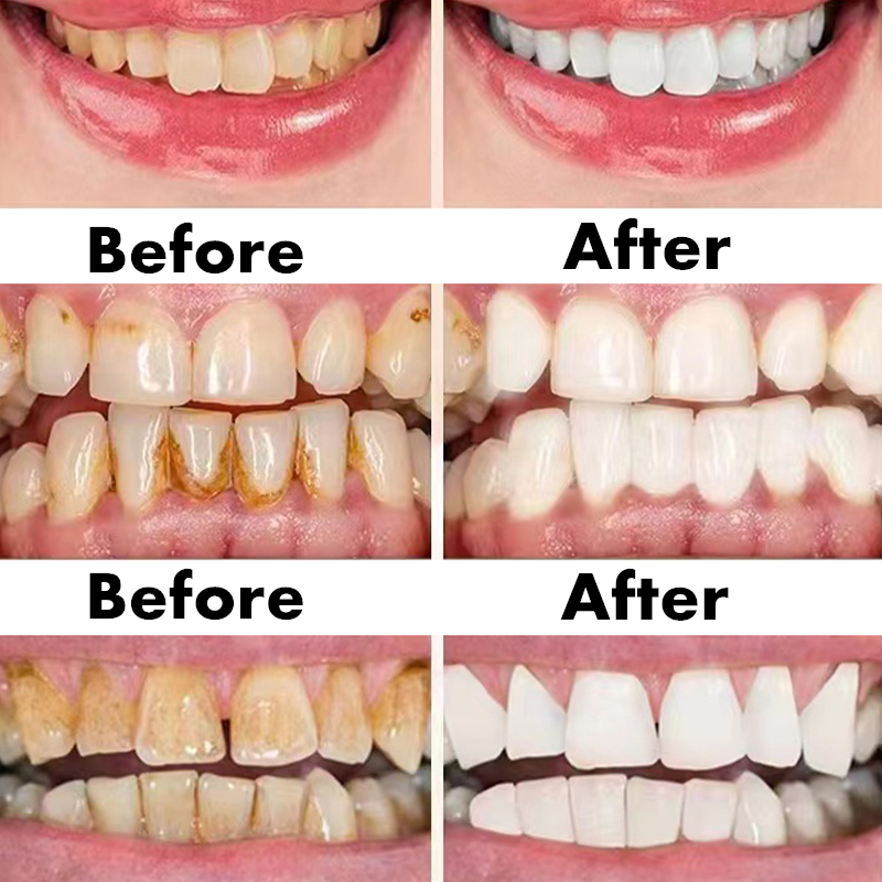 Teeth Whitening Pen Dental Ess - Teeth Whitening Serum ulasan dan harga